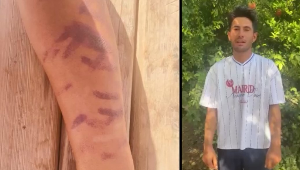 Lazer epilasyon yaptırdığı merkezde kabus yaşadı: “Ben yandım başkaları yanmasın