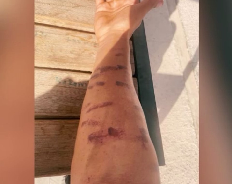 Lazer epilasyon yaptırdığı merkezde kabus yaşadı: “Ben yandım başkaları yanmasın