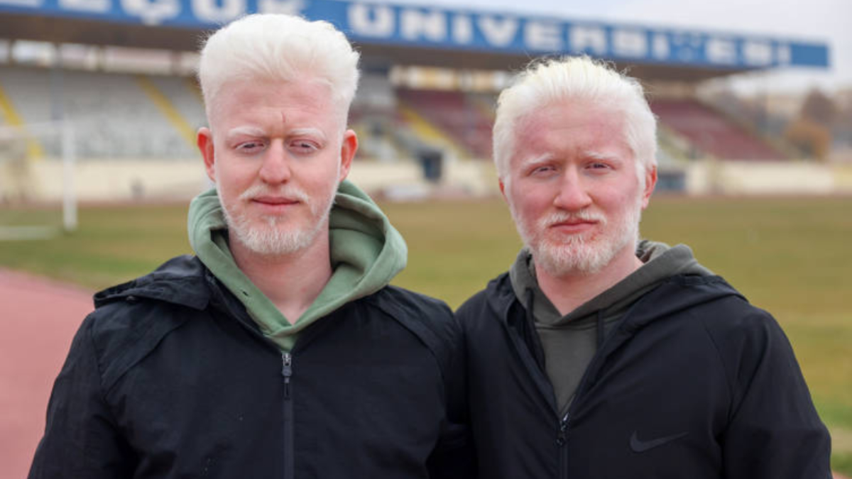 Albinizmli üniversite öğrencileri Muhammet ve Yusuf'un dayanışma hikâyesi