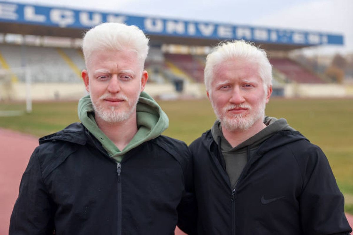 Albinizmli üniversite öğrencileri Muhammet ve Yusuf'un dayanışma hikâyesi