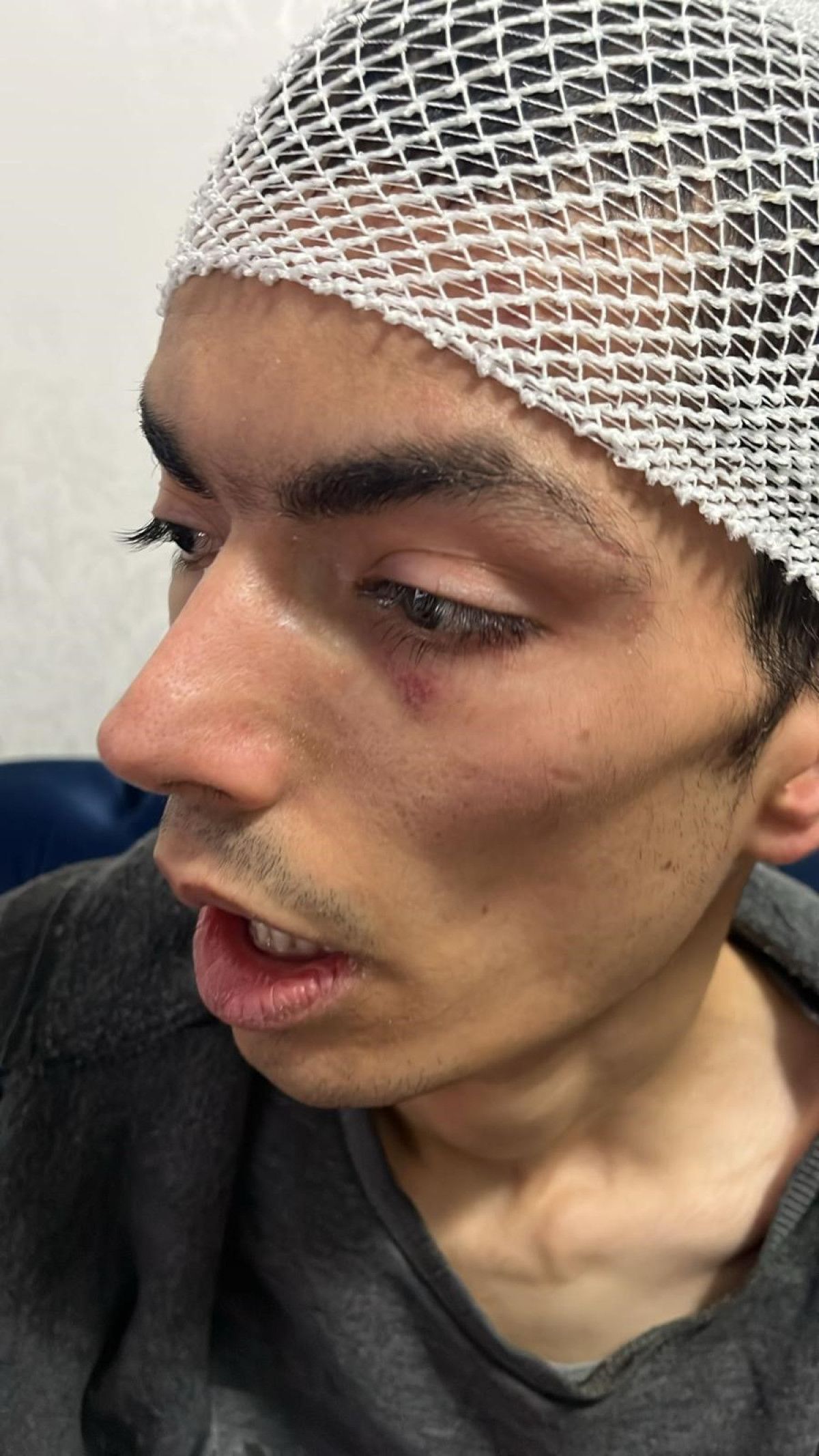 Gaziantep’te engelli bakım merkezinde şiddet: Gencin başına 6 dikiş atıldı