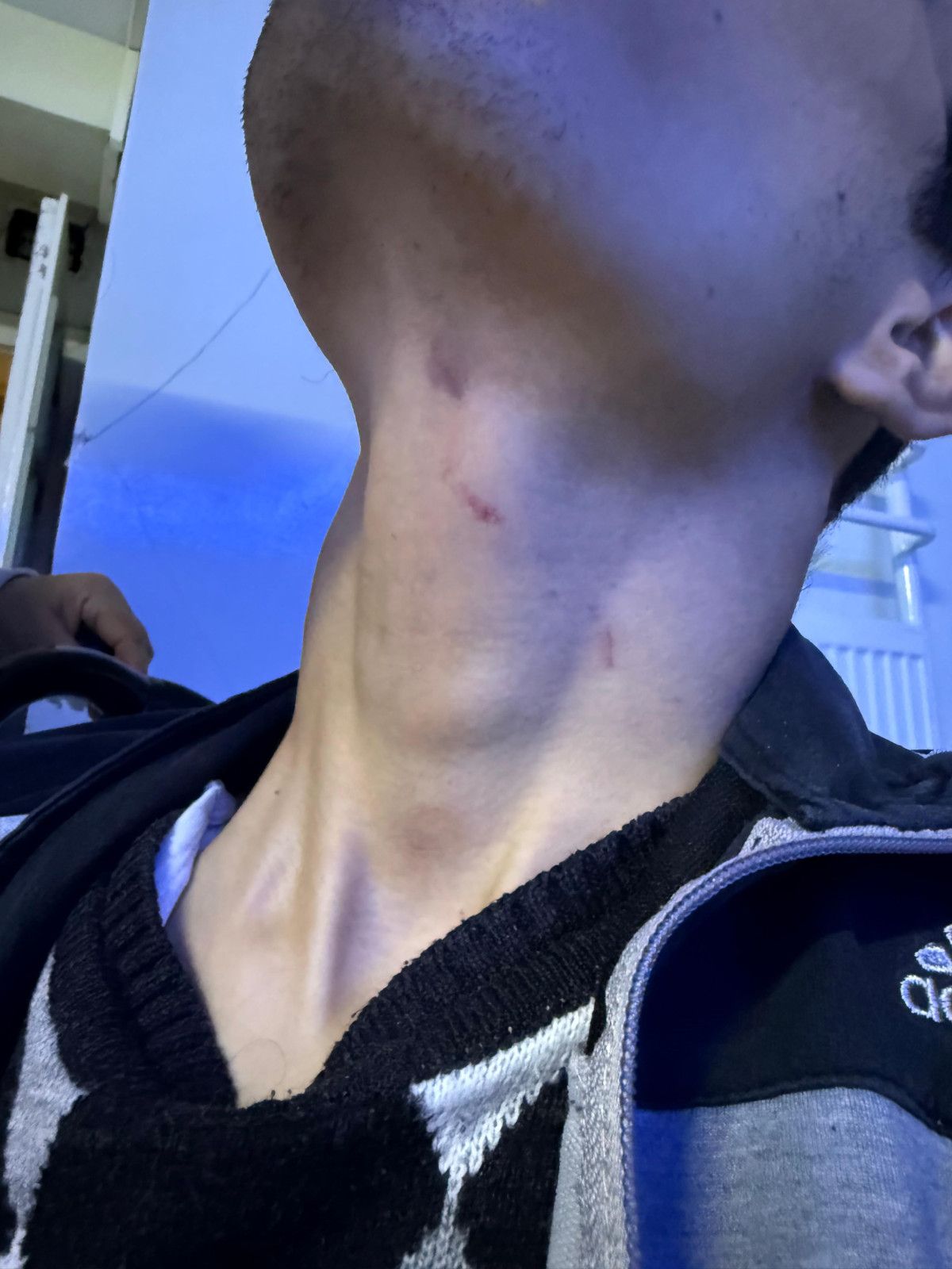 Gaziantep’te engelli bakım merkezinde şiddet: Gencin başına 6 dikiş atıldı