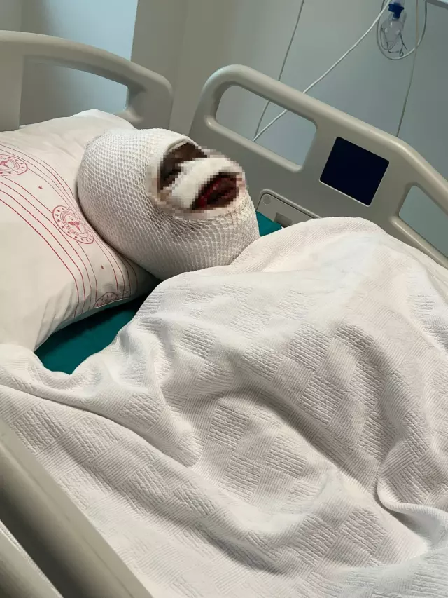 Gaziantep'te Eski Eşine Kezzap Saldırısı: Ağır Yaralanan Kadının Babası Olayın Detaylarını Anlattı