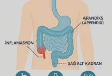 sağ karın ağrısı apandisit - Sağ Karın Ağrısı: Apandisit mi, Başka Şey mi?